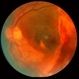 Choroidal Rupture with Extensive Subretinal Hemorrhage HM Choroidal Rupture with Extensive Subretinal Hemorrhage HM